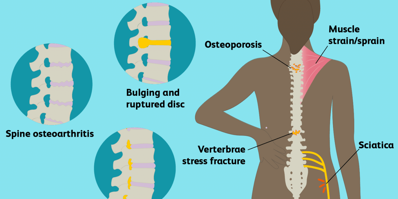 About Back Pain symptoms, cause, Treatment