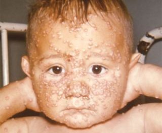 Smallpox – symptoms, causes and prevention