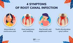 An overview of Root Canal – reason, procedure